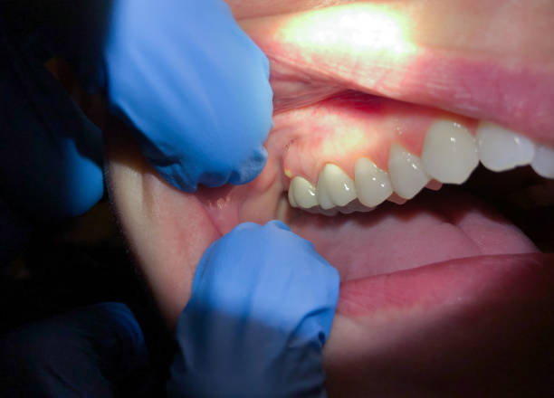 Best Emergency Gum Treatment in Duryea, PA
